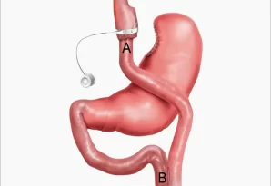 nih_161026_roux_en_y_gastric_bypass_800x600